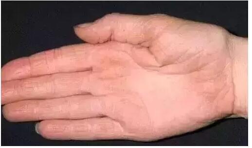 华医皮肤病医院：湿疹与手足癣的区别在哪里